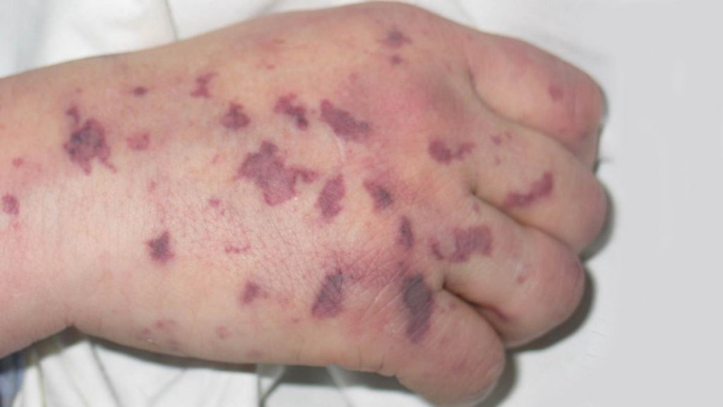 Менінгококова інфекція: все, що потрібно знати про небезпечну хворобу