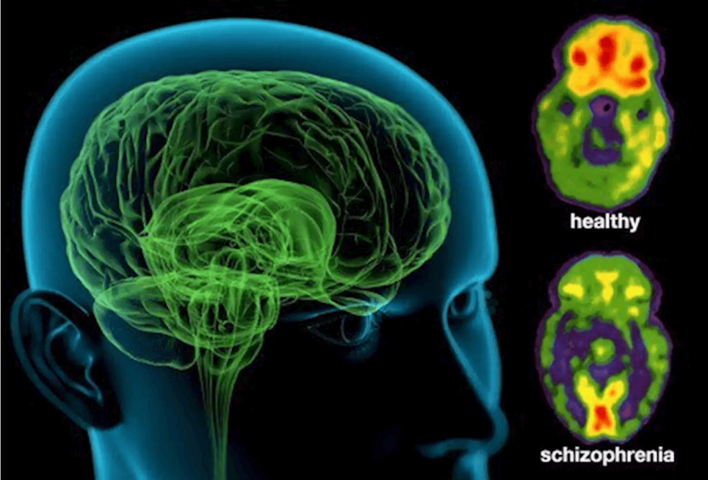 Вчені виявили новий тип шизофренії