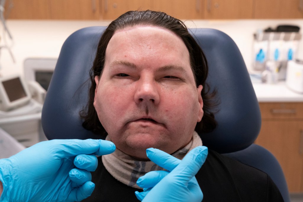 Лікарі у США успішно здійснили трансплантацію обличчя
