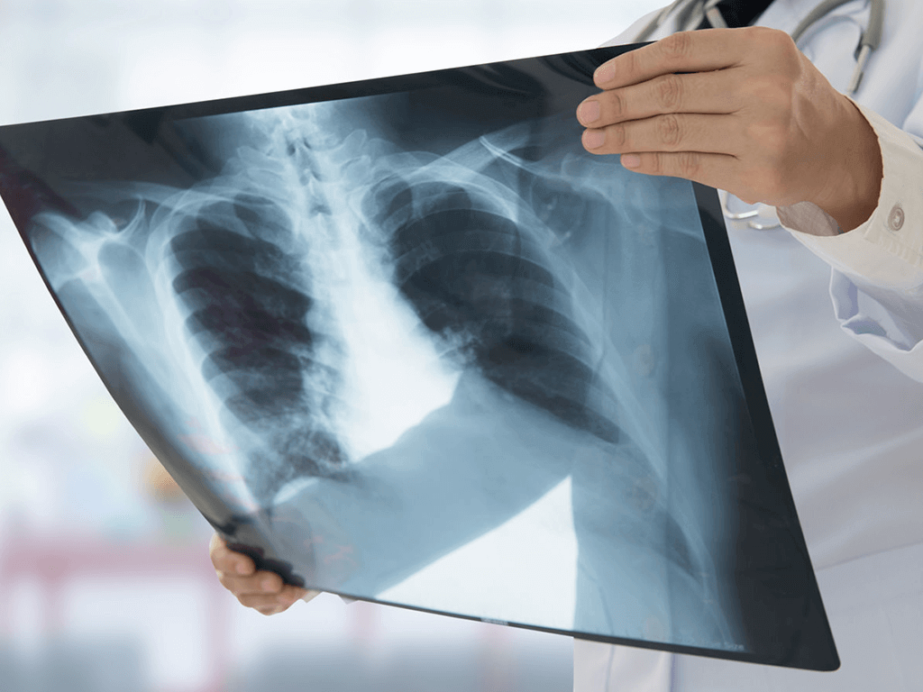 Туберкульоз в Україні