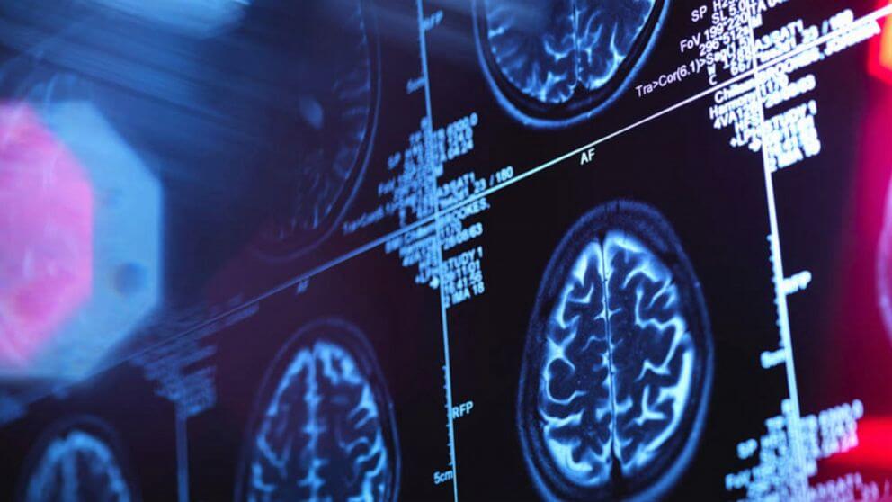 У Канаді більше 40 людей постраждали від невідомого захворювання мозку