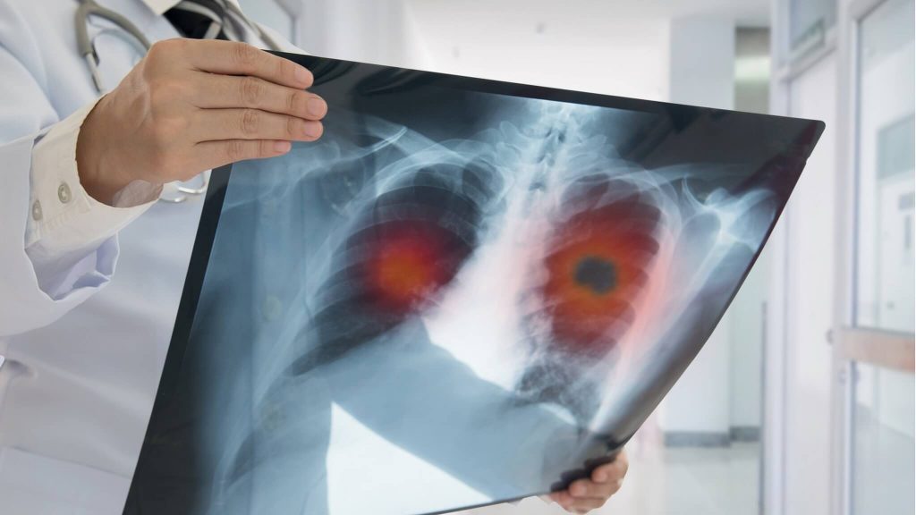 Від раку легень щороку в Україні гине 9 000 людей